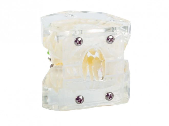 Tandmodel met orthodontische beugels