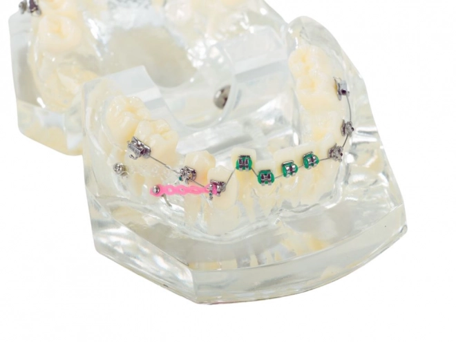 Tandmodel met orthodontische beugels