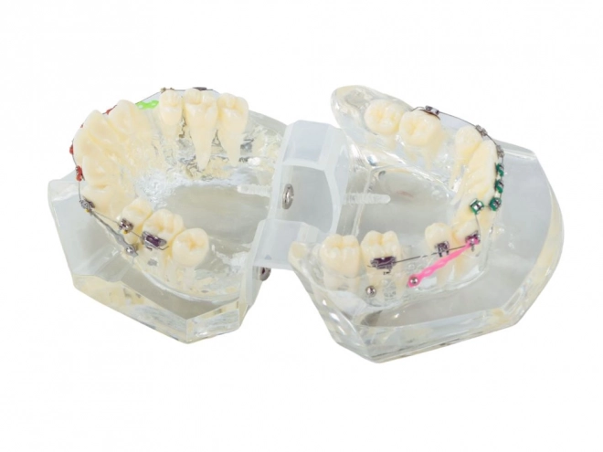 Tandmodel met orthodontische beugels