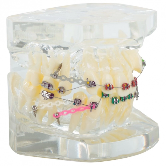 Tandmodel met orthodontische beugels