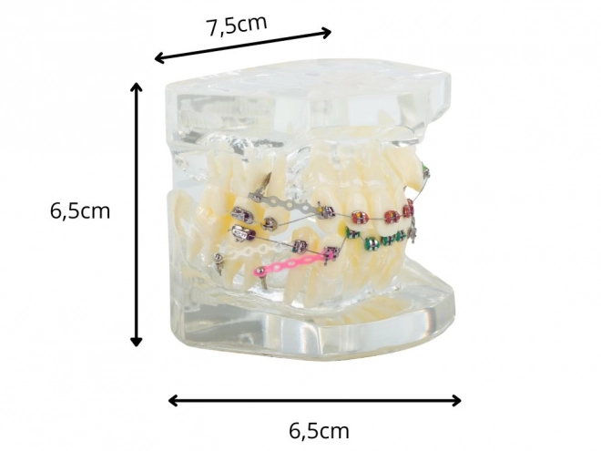 Tandmodel met orthodontische beugels