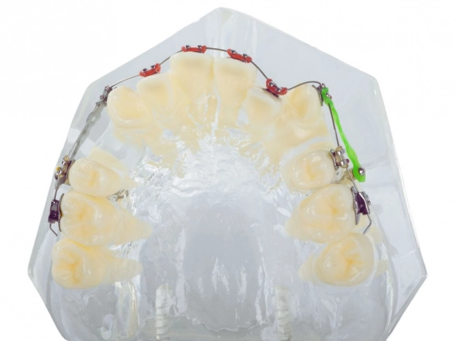 Tandmodel met orthodontische beugels