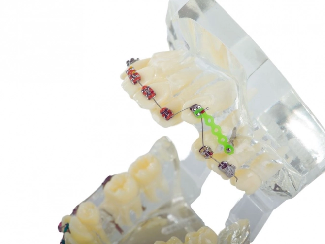 Tandmodel met orthodontische beugels